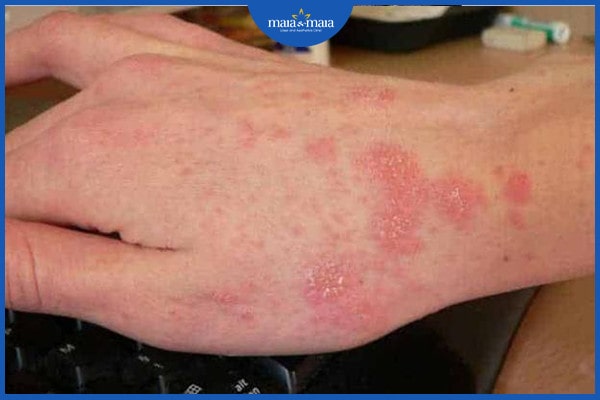 Viêm da dị ứng bội nhiễm 3 viêm da dị ứng