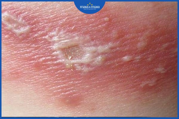 Viêm da dị ứng bội nhiễm 2 viêm da dị ứng bội nhiễm