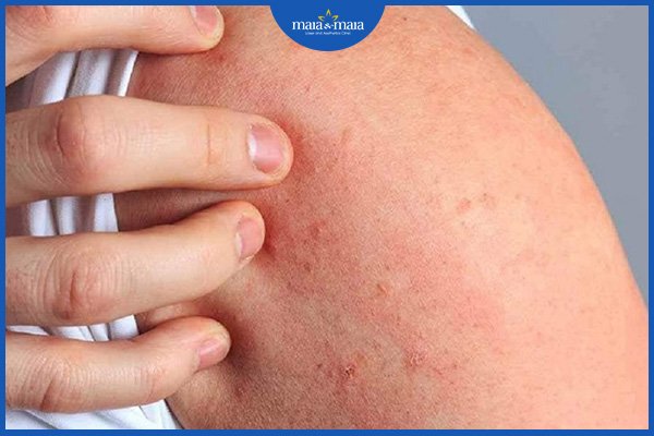 Viêm da dị ứng có lây không? 3 viêm da dị ứng