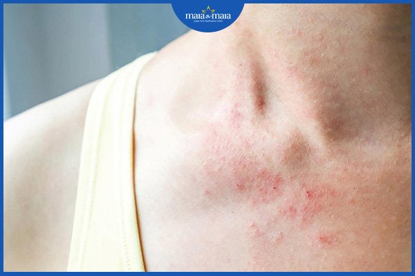 Viêm da dị ứng có lây không? 2 viêm da dị ứng có lây không