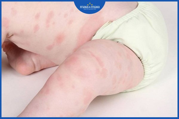 Viêm da dị ứng mãn tính 2 viêm da dị ứng
