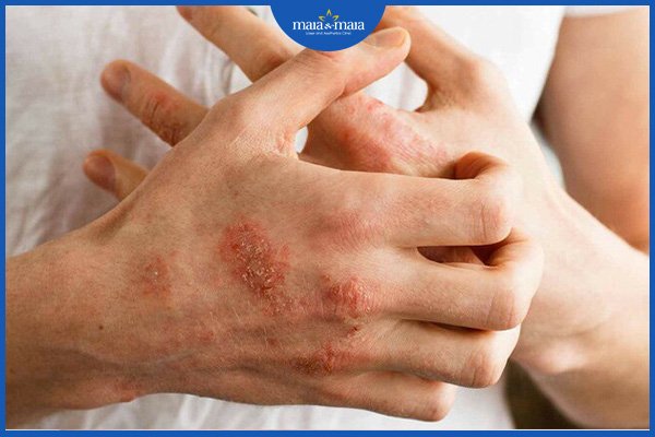 Viêm da dị ứng mãn tính 3 viêm da
