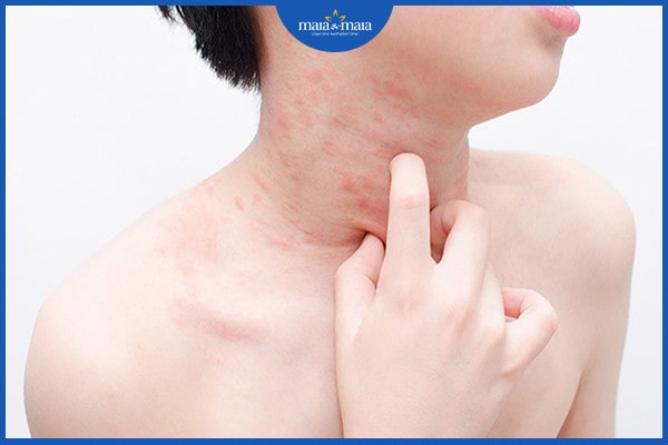 Viêm da dị ứng ở cổ 3 viêm da dị ứng