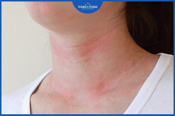 Viêm da dị ứng ở cổ 2 viêm da dị ứng ở cổ