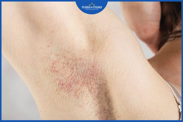 Viêm da dị ứng ở nách 4 viêm da dị ứng