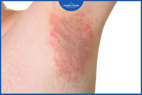 Viêm da dị ứng ở nách 2 viêm da dị ứng