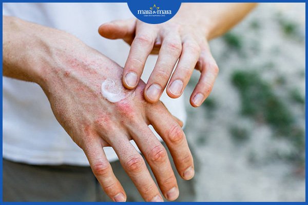 Viêm da dị ứng ở tay chân 2 viêm da dị ứng ở tay chân