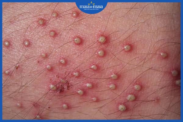 Biểu hiện của viêm nang lông - nhận biết để điều trị đúng cách 4 bệnh viêm nang lông