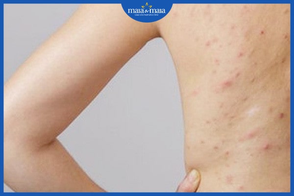 Biểu hiện của viêm nang lông - nhận biết để điều trị đúng cách 3 Biểu hiện của viêm nang lông