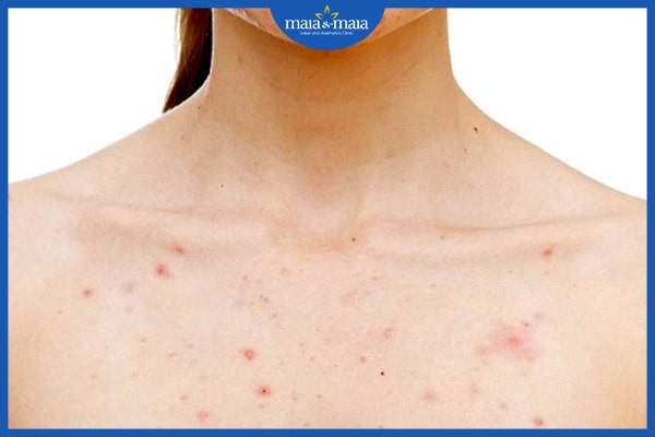 Biểu hiện của viêm nang lông - nhận biết để điều trị đúng cách 2 Biểu hiện của viêm nang lông