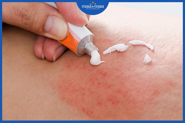 Điều trị bệnh viêm nang lông thế nào? Phương pháp nào hiệu quả nhất? 3 điều trị bệnh viêm nang lông