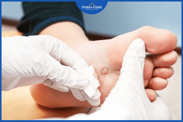 Mụn cóc có lây không? 4 đường lây nhiễm mụn cóc nhanh chóng 4 dieutrimuncoctaivien optimized