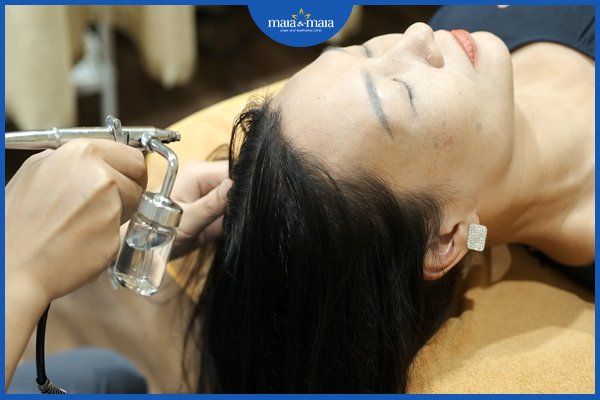 Hói đầu chữ M - Nguyên nhân và biện pháp khắc phục 3 điều trị hói đầu