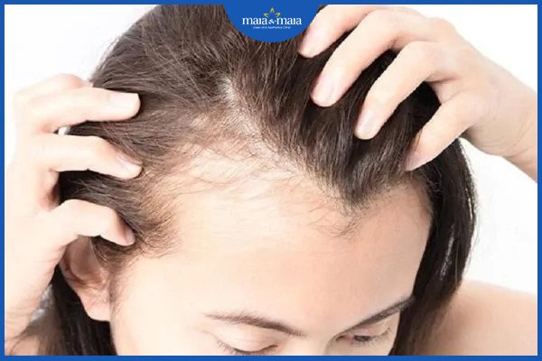 Hói đầu chữ M - Nguyên nhân và biện pháp khắc phục 2 hói đầu chữ m