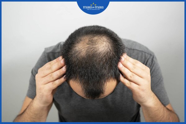 Hói đầu di truyền có chữa được không? 3 Hói đầu di truyền