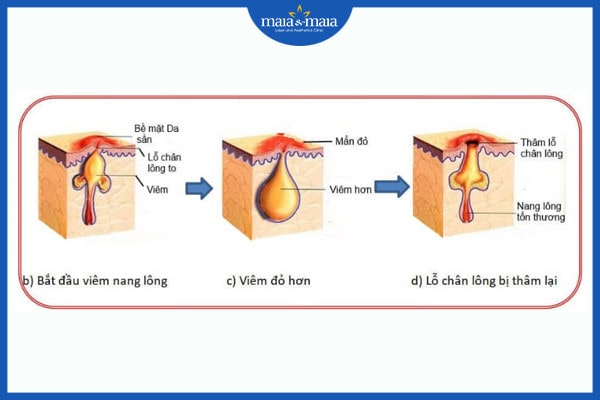 Nang lông bị tắc nghẽn, nguyên nhân là gì? 2 Nang lông bị tắc nghẽn