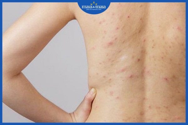 Nang lông bị tắc nghẽn, nguyên nhân là gì? 3 Nang lông tắc nghẽn