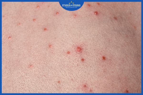 Tìm hiểu nguyên nhân dẫn đến viêm nang lông là gì? 4 viêm nang lông