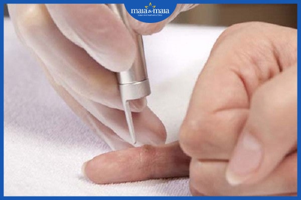 Nổi mụn cóc ở tay - nguyên nhân và cách điều trị bạn cần biết! 3 mụn cóc