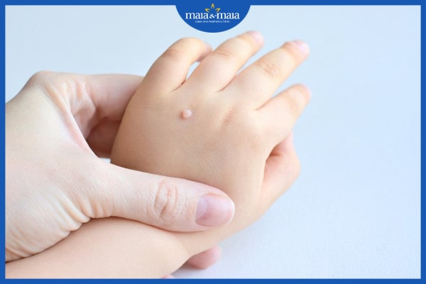 Nổi mụn cóc ở tay - nguyên nhân và cách điều trị bạn cần biết! 2 nổi mụn cóc ở tay