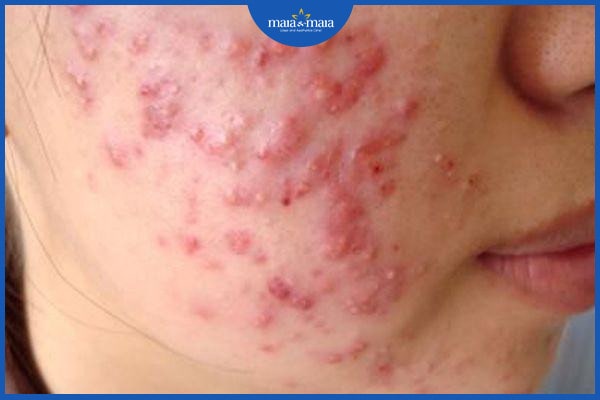 Phân biệt viêm nang lông và mụn trứng cá để điều trị hiệu quả 2 Phân biệt viêm nang lông và mụn trứng cá