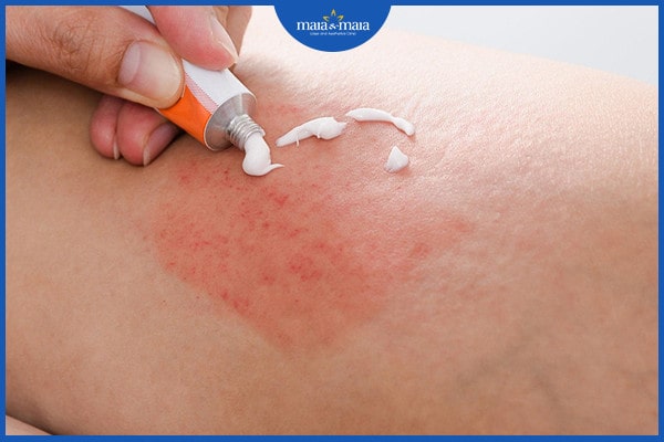 Phân biệt viêm nang lông và mụn trứng cá để điều trị hiệu quả 4 Phân biệt viêm nang lông và mụn trứng cá