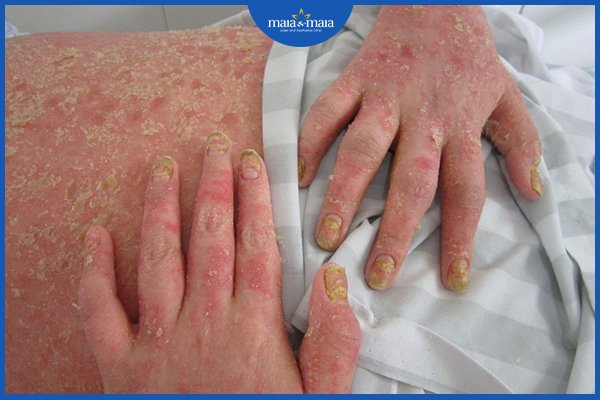 Vảy nến đỏ da toàn thân - Triệu chứng và cách điều trị 2 vảy nến toàn thân