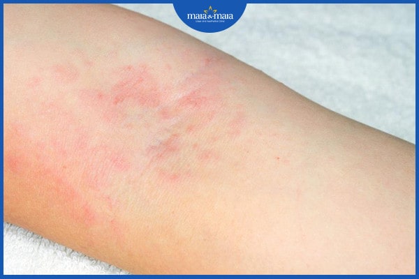 Viêm lỗ chân lông ở chân tay và những điều bạn cần biết! 2 viêm lỗ chân lông ở chân tay