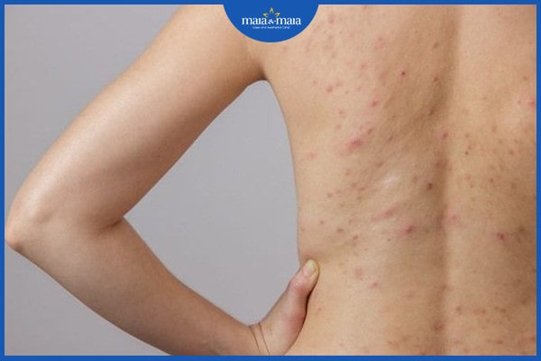 Viêm nang lông có lây không? Làm sao để điều trị dứt điểm? 3 Viêm nang lông