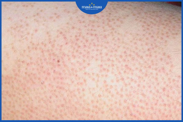 Viêm nang lông nông là gì? Dấu hiệu và cách điều trị hiệu quả 2 Viêm nang lông nông