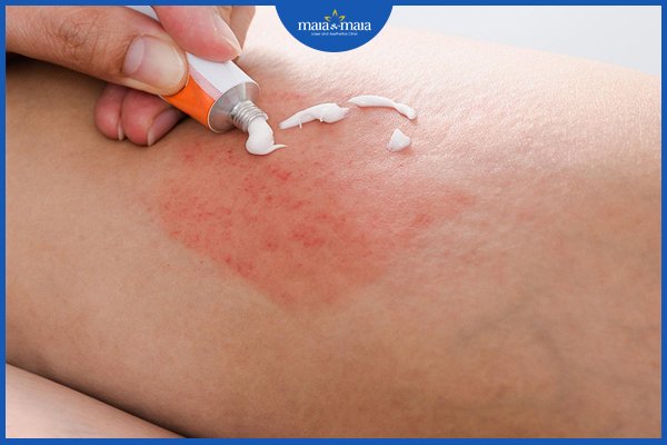 Các phương pháp điều trị viêm nang lông ở bụng hiệu quả nhất hiện nay 2 viêm nang lông ở bụng