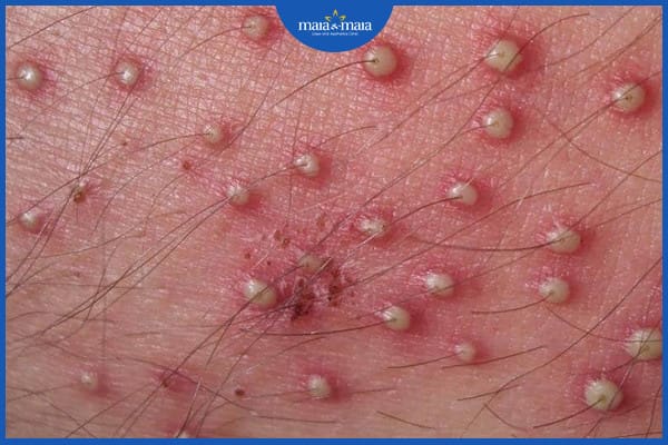 Viêm nang lông sâu là gì? Nguyên nhân và phương pháp điều trị 2 Viêm nang lông sâu