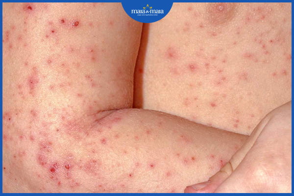 Bệnh chàm nang lông - Nguyên nhân, triệu chứng và cách điều trị 2 Bệnh chàm nang lông