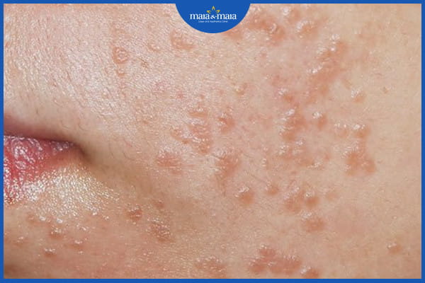 Dấu hiệu của mụn cóc - Nhận biết chính xác để tránh nhầm lẫn 3 dấu hiệu của mụn cóc