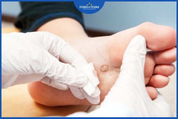 Hạt cơm phẳng là gì? Những cách chữa hạt cơm phẳng hiện nay 3 Hạt cơm phẳng