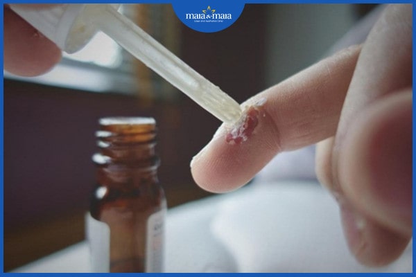 Mụn cóc thông thường: Biểu hiện, nguyên nhân và phương pháp điều trị 3 Mụn cóc thông thường