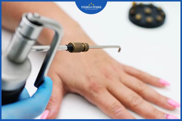 Mụn cóc thông thường: Biểu hiện, nguyên nhân và phương pháp điều trị 4 Lột mụn với axit salicylic