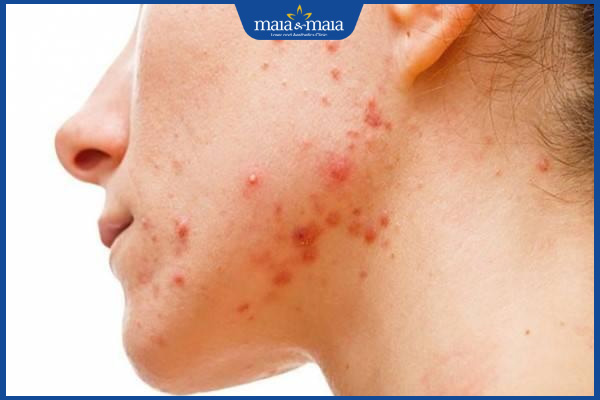 mụn trứng cá dạng nang