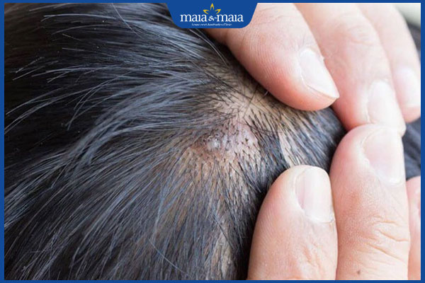 Mụn trứng cá trên da đầu nguy hiểm không? Nguyên nhân và cách điều trị 3 mụn trứng cá do nang tóc bít tắc