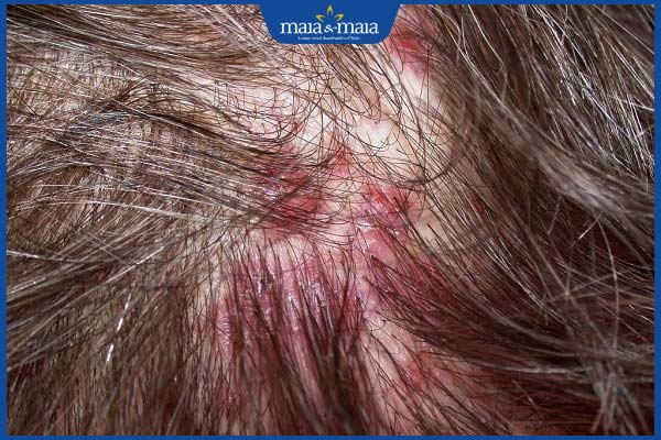 Mụn trứng cá trên da đầu nguy hiểm không? Nguyên nhân và cách điều trị 2 mụn trứng cá trên da đầu