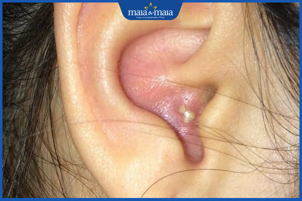 Mụn trứng cá ở tai có nguy hiểm không? Điều trị ở đâu hiệu quả? 2 mụn trứng cá trong tai