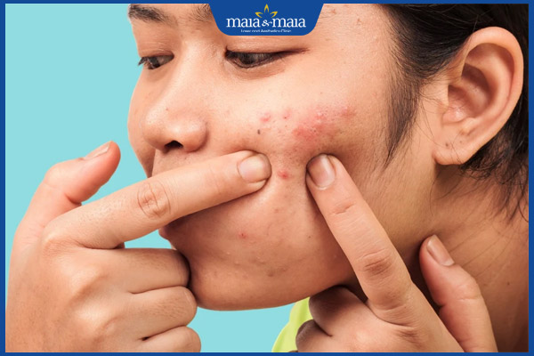 nặn mụn trứng cá sai cách