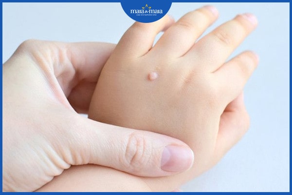 Nguyên nhân hình thành mụn cóc là gì? Mụn cóc có lây không? 3 Nguyên nhân hình thành mụn cóc
