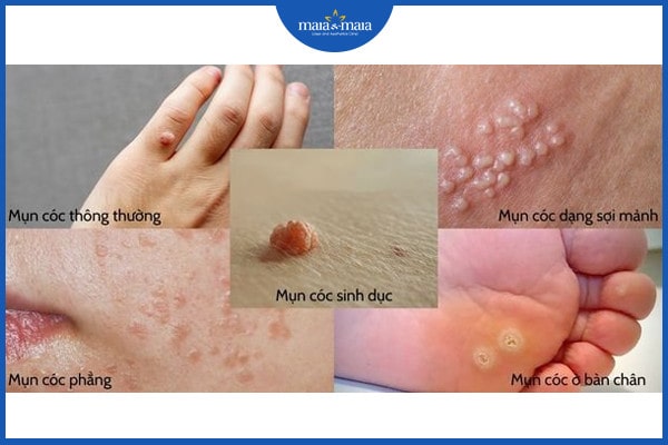 Nguyên nhân hình thành mụn cóc là gì? Mụn cóc có lây không? 4 Nguyên nhân hình thành mụn cóc