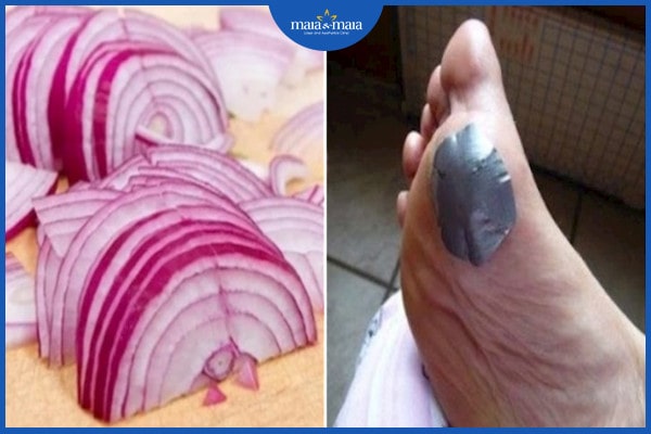 Trị mụn cóc bằng hành tím có thực sự hiệu quả hay không? 4 Trị mụn cóc bằng hành tím kết hợp với Aspirin