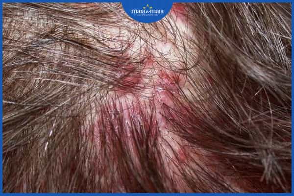 Viêm nang lông da đầu có lây không? Điều trị ở đâu hiệu quả? 2 Viêm nang lông da đầu có lây không