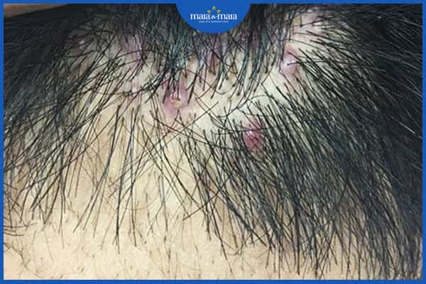 Viêm nang tóc là bệnh gì? Tìm hiểu để tránh hậu quả đáng tiếc 2 Viêm nang tóc là bệnh gì