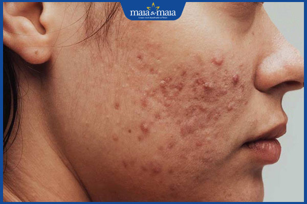 Mụn trứng cá gây ngứa là do đâu? Cần làm gì để ngăn ngừa? 4 bị ngứa do mụn trứng cá