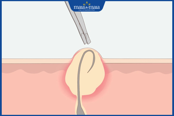 Mụn trứng cá bọc ở mũi: nguyên nhân, cách điều trị và phòng ngừa 2 lông mọc ngược gây mụn trứng cá