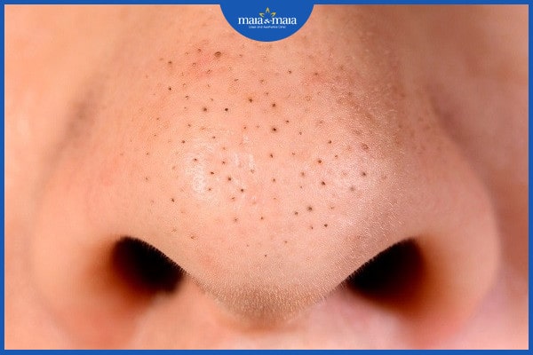 Mụn trứng cá có mùi hôi là do đâu? Cách khắc phục hiệu quả 2 mụn trứng cá có mùi hôi